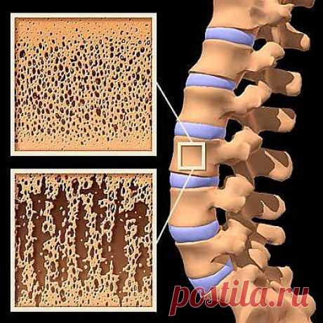 Остеопороз - незаметный враг.