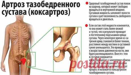 Бугун артрозни даволашда бир қанча муолажа усуллари жорий қилинган.