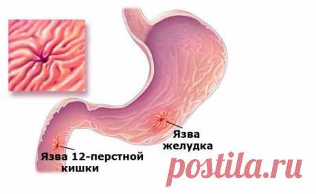 ЛЕЧИМСЯ ДОМА-ЛЕЧЕНИЕ ЯЗВЫ ДВЕНАДЦАТИПЕРСТНОЙ КИШКИ