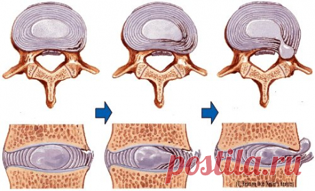 Грыжа - как лечить без операции и лекарств?!