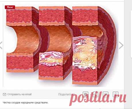 Чистка сосудов народными средствами. Если вы... / Уход за собой / С пользой для здоровья / Pinme.ru / Georgina
