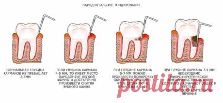 Пародонтоз. Причины, симптомы, лечение. Можно ли вылечить в домашних условиях?