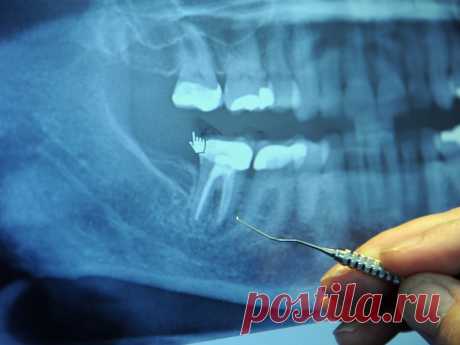 Перед заболеванием 97% больных раком делали эту стоматологическую процедуру