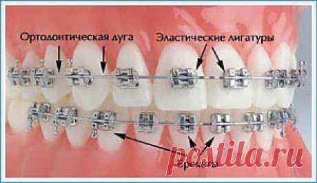 Как исправить прикус ребенка? Брекеты &amp;#8212; виды и цены. | Планета детства