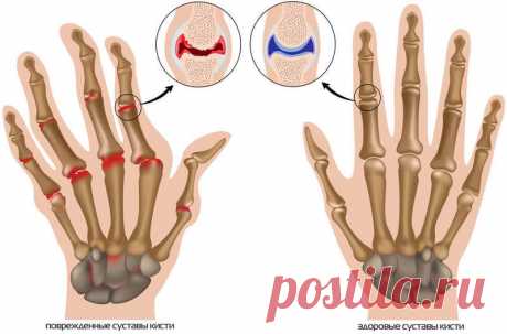 Упражнения для лечения артроза пальцев рук Методика, разработанная Виталием Гиттом и успешно применяемая многие годы для лечения заболеваний суставов, поможет и при лечении артрозов и артритов. Правда, в этих случаях на первый план выходят не …