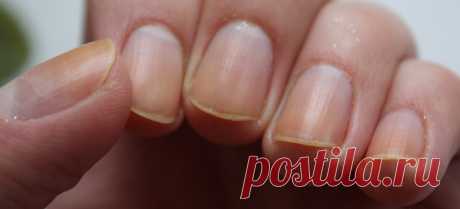 ЛЕГКИЕ СПОСОБЫ ЛЕЧЕНИЯ ОТСЛАИВАНИЯ НОГТЕЙ
Позаботьтесь о ноготках Иногда вы можете обнаружить горизонтальные трещины на ногтях, которые приводят к отслаиванию тонких слоев ногтей. Существует несколько причин расщепления или шелушения ногтей. Ногти состоят из слоев волокнистого белка, известного как кератин, который также содержится в волосах и коже. Кератин укрепляет ногти, но внешние...
Читай пост далее на сайте. Жми ⏫ссылку выше
