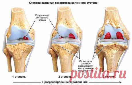 Артрит-артроз - как лечить без операции и лекарств?!