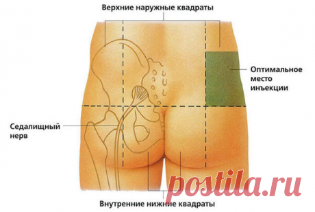 Как правильно сделать укол в ягодицу в домашних условиях? | Домашний способ | Яндекс Дзен