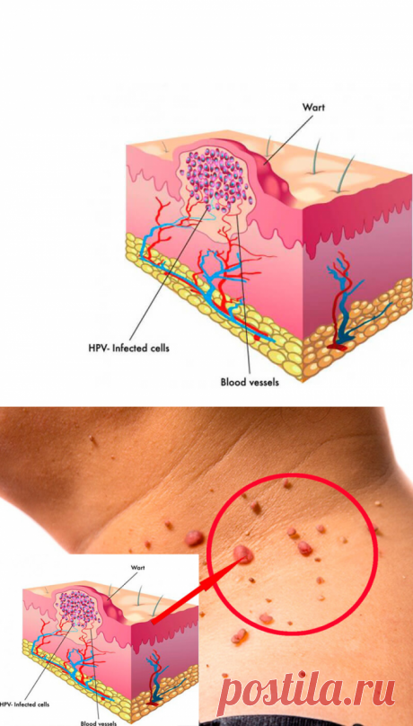 Что делать с папилломами на шее