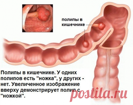 Симптомы полипов в толстом кишечнике - Шаг к Здоровью