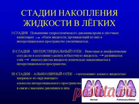 жидкость в плевре легких причины и лечение: 2 тыс изображений найдено в Яндекс Картинках