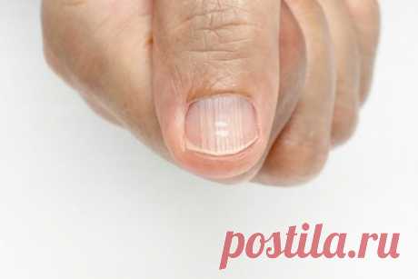 Полоски на ногтях: откуда они и как предотвратить их появление? Белые тонкие или толстые горизонтальные линии и полоски на ногтях могут появляться по разным причинам. Узнайте об этом больше из нашей статьи.