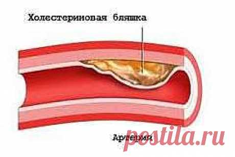 холестерин в крови | Рецепты народной медицины