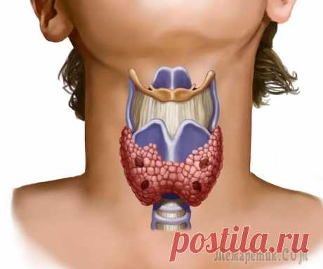 Зоб щитовидной железы симптомы и лечение