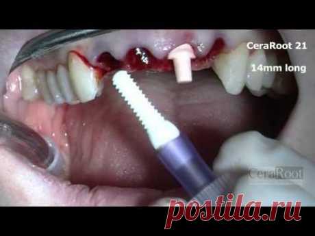 Surgery of 4 upper incisors with CeraRoot zirconia implants.