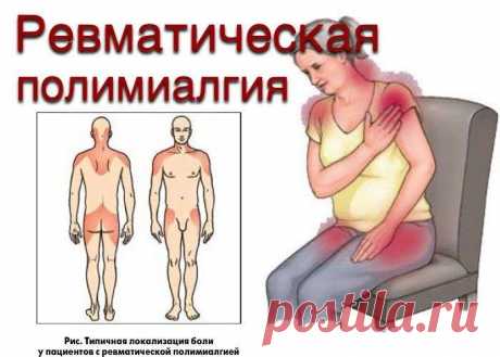 Ревматическая полимиалгия – боли ревматического характера, одновременно возникающие в разных группах мышц.

Ревматическая полимиалгия характеризуется мышечными болями и скованностью, более выраженными по утрам и уменьшающимися в течение дня; боли обычно локализуются в мышцах шеи, плеч, позвоночника, бедер, ягодиц.