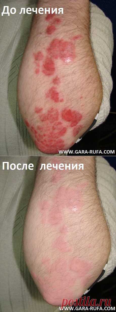 Лечение кожных заболеваний рыбой-доктором Гарра Руфа(Garra Rufa).Рекомендации и противопоказания.