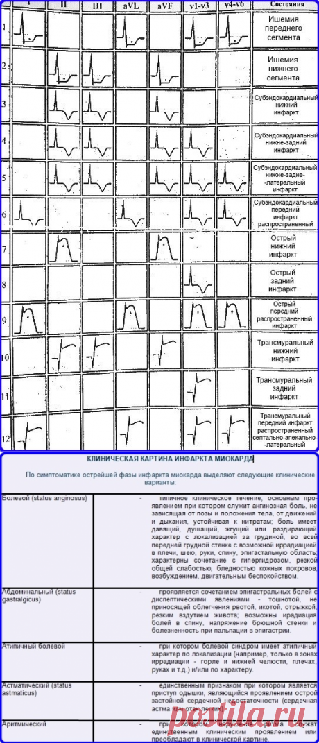 • ЭКГ признаки инфаркта миокарда - Шпаргалки для "скорой помощи"