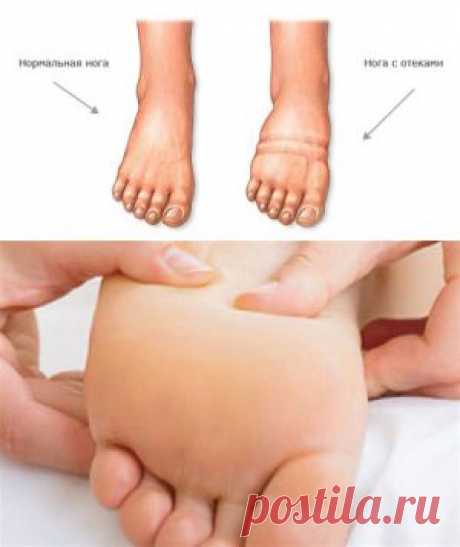Отек стопы правой ноги: причины и лечение