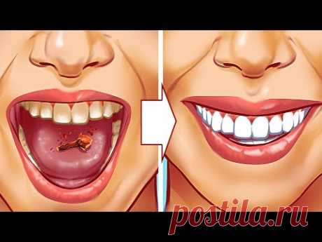 10 Натуральных Способов Устранить Зубной Камень