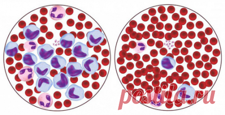 Почему понижены лимфоциты и что с этим делать