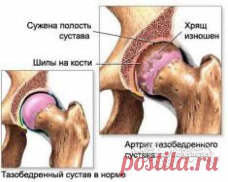 НАСТУПИТ СРОК, УЙДЁТ АРТРИТ И БОЛЬШЕ ВАС НЕ ПОСЕТИТ