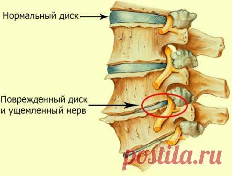 Простое домашнее средство от остеохондроза позволит забыть о боли лет на 5 Остеохондроз — распространенное заболевание, при котором возникает дистрофия ткани межпозвоночных дисков, в результате чего позвоночник теряет свойственную ему гибкость. Спровоцировать начало этого заболевания может чрезмерная нагрузка на позвоночник, травма в результате падения или удара,...