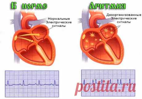 Особенности мерцательной аритмии сердца — симптомы и методы лечения | За Здравие: методы лечения народными средствами в домашних условиях от Захара Олеговича Журавлева