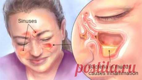 Избавьтесь от гайморита в течение нескольких минут, благодаря ингредиенту, который уже у вас на кухне! Гайморит (синусит) — это состояние воспаленной подкладки стен пазух. Эта проблема затрагивает многих людей, и они...