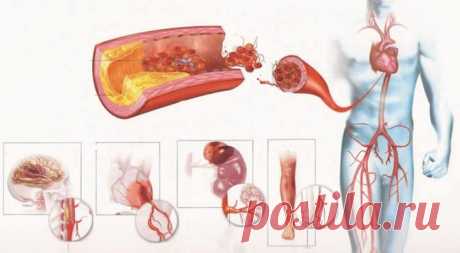 Точечный массаж при атеросклерозе и плохой памяти Атеросклероз – это опасное для человека заболевание, поражающее кровеносную систему человека, его сосуды. При его развитии на внутренних стенках вен и сосудов образуется налет из холестерина и иных жи...