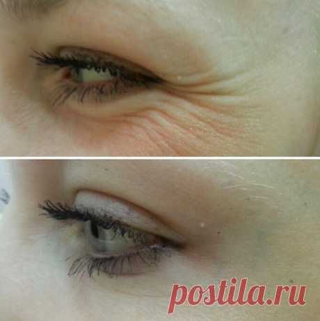 3 процедуры, которые помогут уменьшить «гусиные лапки» под глазами - CELEBNIK. RU