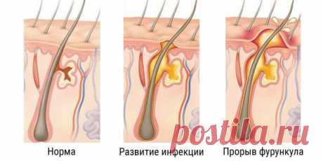 Как лечить фурункул, чтобы не заработать заражение крови - Лайфхакер