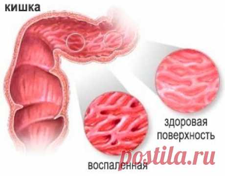 Все о катаральном колите кишечника. Симптомы, причины, лечение