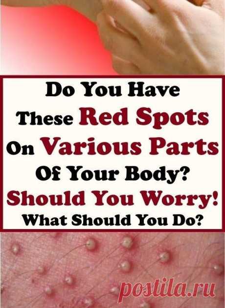 Do You Have These Red Spots On Various Parts Of Your Body? Should You Worry! What Should You Do?