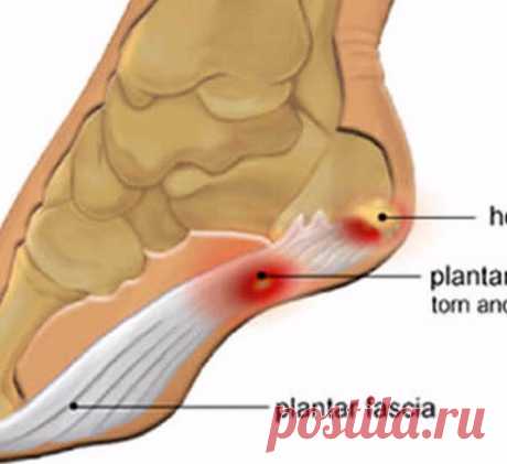 Плантарный фасциит: Узнайте как облегчить боль при помощи простого средства! Экология здоровья: Плантарный фасциит возникает, когда фасция воспаляется, это может происходить из-за перегрузки, растяжения или неудобной обуви.