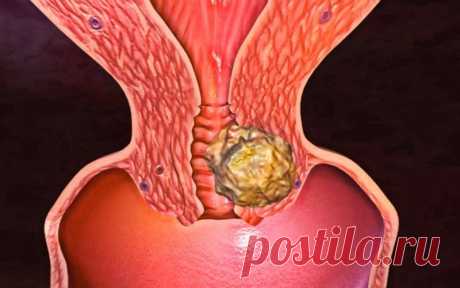 Вовремя заметить, чтобы спастись: главные признаки рака шейки матки