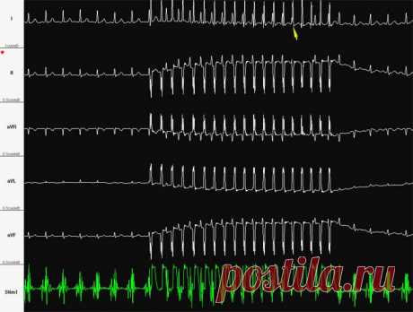 Сердечная аритмия. Причины, симптомы, современная диагностика и эффективное лечение :: Polismed.com