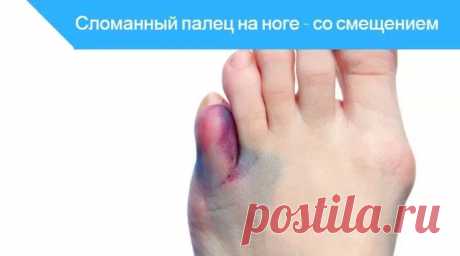 Перелом пальца ноги - без смещения