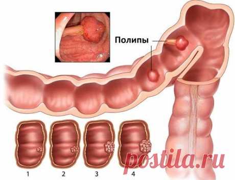 - Лечение полипоза в желудке травами: чистотел, калина -