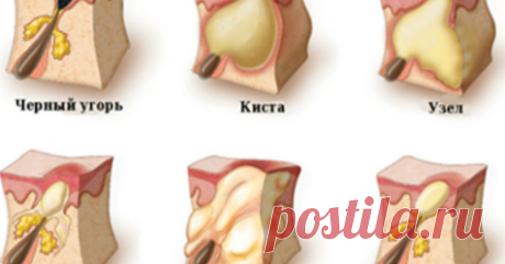 КРАСОТА ЗДОРОВЬЕ Как избавиться от подкожного прыща? Лечение внутренних прыщей народными средствами и медицинскими препаратами