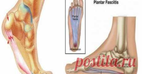 Болит ли ваша пятка утром или когда вы встаете? Это то, что вам нужно знать - Упражнения и похудение Это важно! Шпоры — это патология, которая поражает пятку, как раз в области сухожилий. Эта патология создает большую боль в этой части пятки, предотвращая реализацию многих наших ежедневных действий. Эта боль обычно вызвана тем, что долгое время вы не принимали неподходящие позиции или носили неподходящую обувь. Боль также может возникнуть, когда мы перегружаем наши ноги …