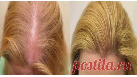 Останови выпадение волос и оживи «уснувшие» волосяные луковицы