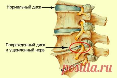 Простое домашнее средство от остеохондроза позволит забыть о боли - Interesno - website