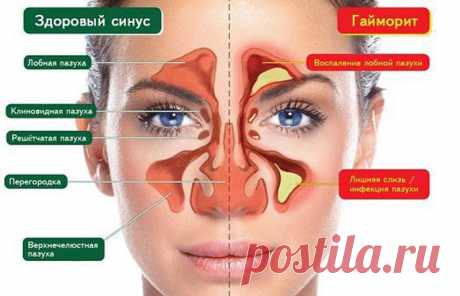 5 природных средств для защиты от синусита Причины хронического синусита могут быть разные: чрезмерное потребление молочных продуктов (сыр, молоко, мороженое, йогурты и т.д.) аллергия на окружающую среду