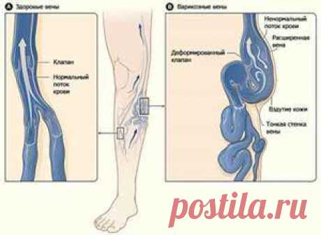 Что делать при варикозном расширении вен? часть 2