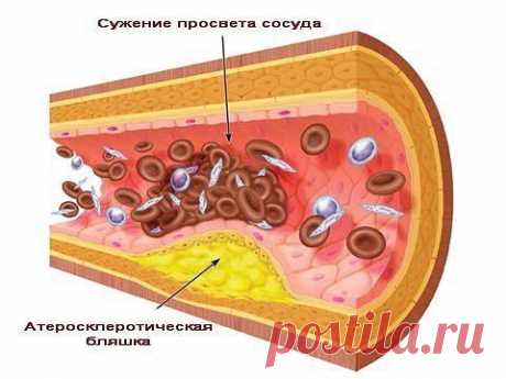 Лечение тромбоза сосудов народными средствами

Тромбоз сосудов – механизм развития болезни