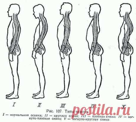 Сколиоз.