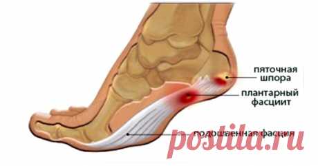 У вас болит пятка по утрам или когда вы встаете? Это то что вам нужно знать! | WebVinegret