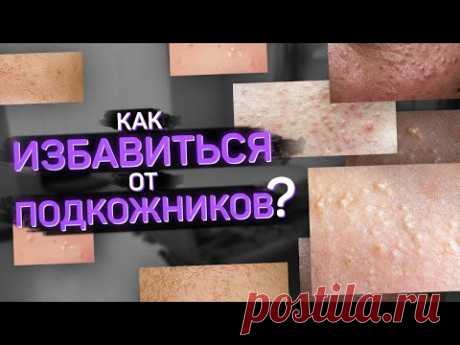 Подкожники. Что такое и как от них избавиться?