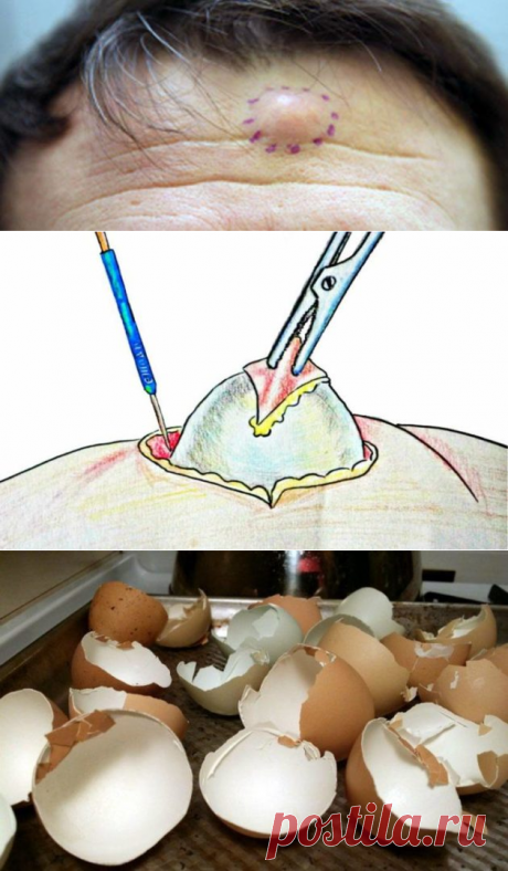 Как вывести жировик народным методом: поможет пленка под скорлупой куриного яйца